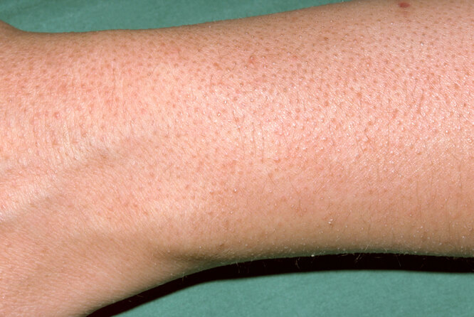 Что такое шелушение кожи