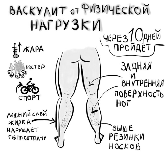 Высыпания на коже летом: топ-4 причины