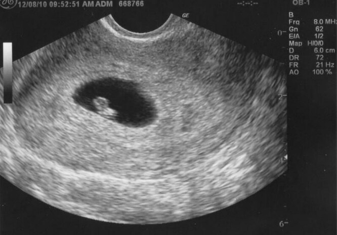 6 неделя беременности: признаки, ощущения, размер и развитие плода
