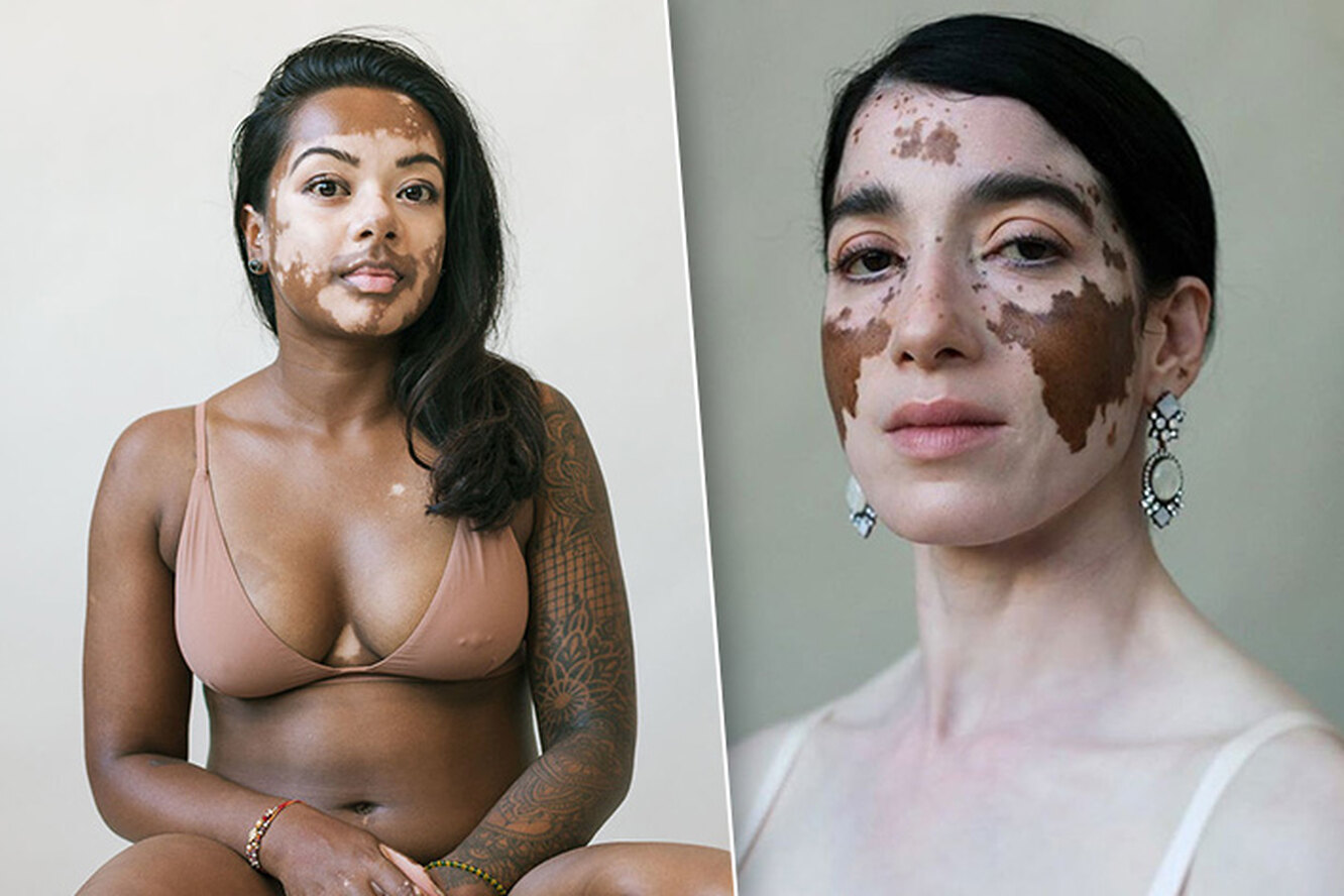Chantal lacroix vitiligo