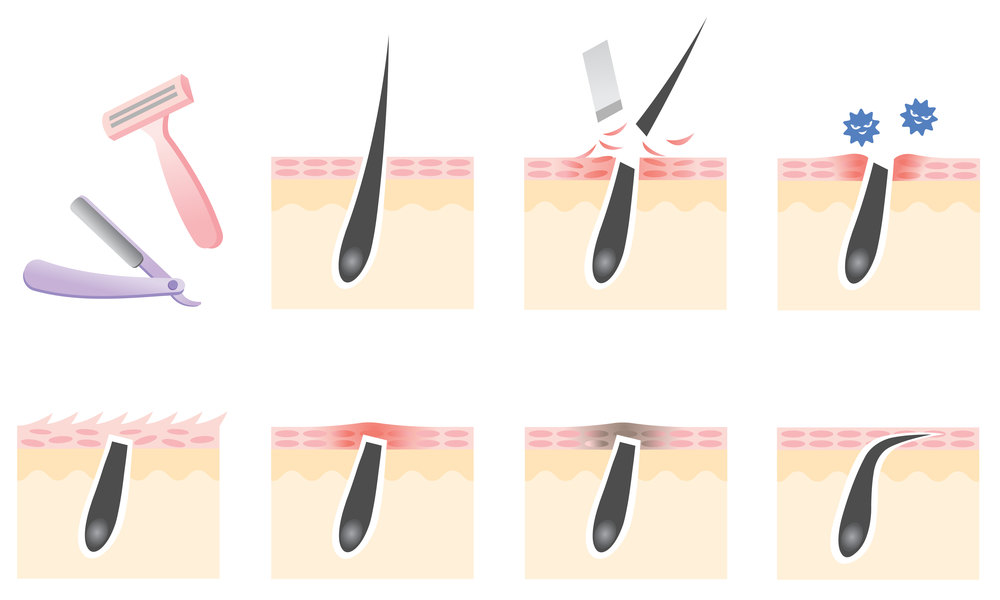 Всё будет гладко: как избавиться от вросших волос после эпиляции